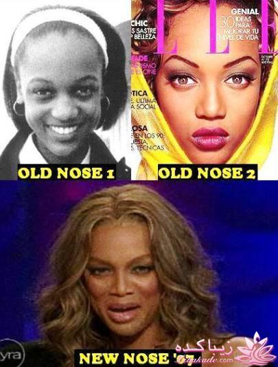 جراحی بینی - جراحی زیبایی