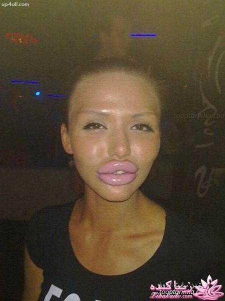 پروتز دائمی لب به خطرش می‌ارزد؟!