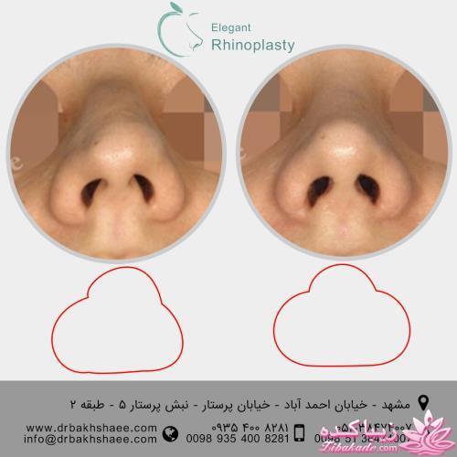 جراحی بینی - جراحی زیبایی