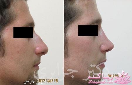 جراحی بینی - جراحی زیبایی