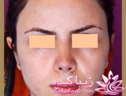 جراحی بینی - جراحی زیبایی