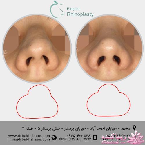 جراحی بینی - جراحی زیبایی