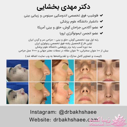 جراحی بینی - جراحی زیبایی