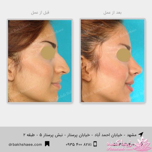 جراحی بینی - جراحی زیبایی