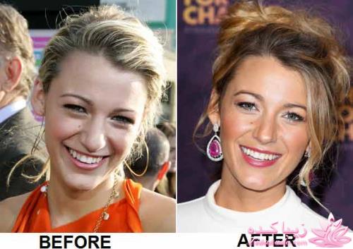 جراحی بینی - جراحی زیبایی