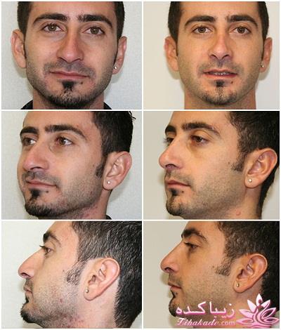 جراحی بینی - جراحی زیبایی