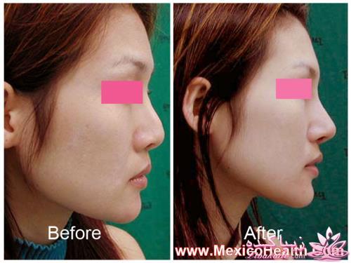 جراحی بینی - جراحی زیبایی