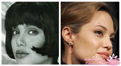 جراحی بینی - جراحی زیبایی