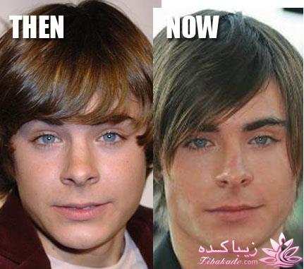 جراحی بینی - جراحی زیبایی