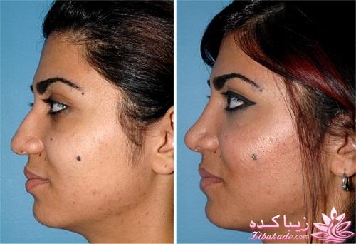 جراحی بینی - جراحی زیبایی