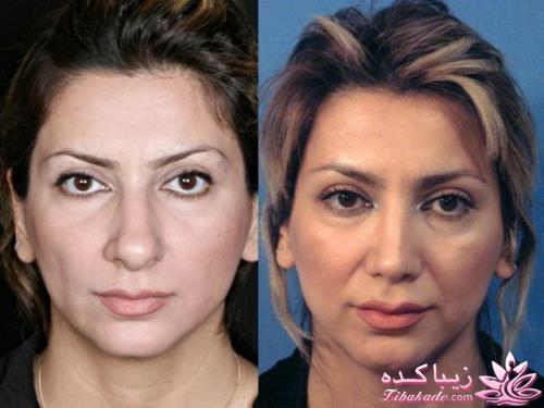 جراحی بینی - جراحی زیبایی