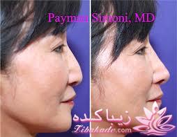 جراحی بینی - جراحی زیبایی