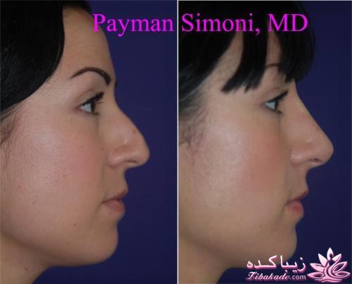 جراحی بینی - جراحی زیبایی