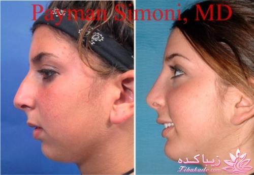 جراحی بینی - جراحی زیبایی