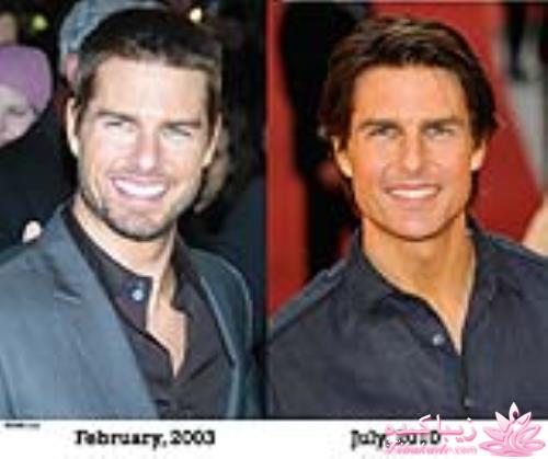 جراحی بینی - جراحی زیبایی