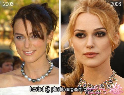 جراحی بینی - جراحی زیبایی