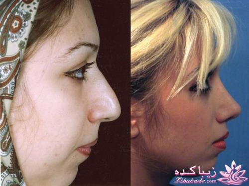 جراحی بینی - جراحی زیبایی