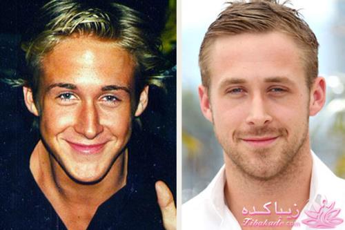 جراحی بینی - جراحی زیبایی