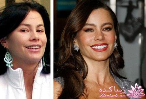 جراحی بینی - جراحی زیبایی