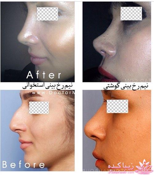 جراحی بینی - جراحی زیبایی