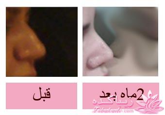 جراحی بینی - جراحی زیبایی