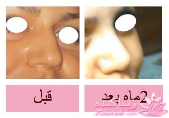 جراحی بینی - جراحی زیبایی