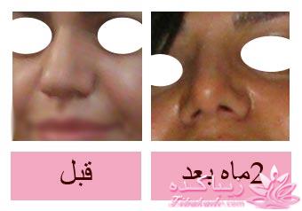 جراحی بینی - جراحی زیبایی