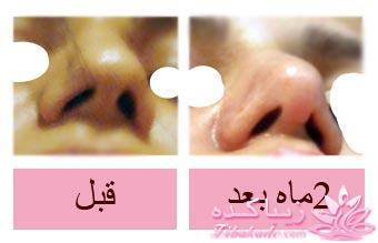 جراحی بینی - جراحی زیبایی