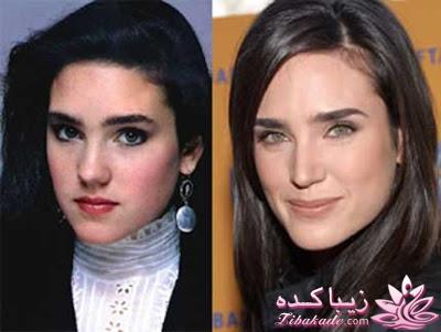 جراحی بینی - جراحی زیبایی