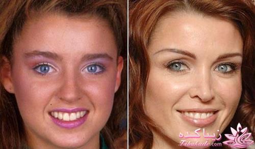 جراحی بینی - جراحی زیبایی