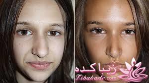 جراحی بینی - جراحی زیبایی