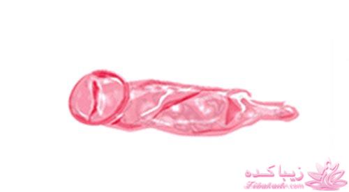 کاندوم - کاندوم زنانه در ایران برای نخستین بار