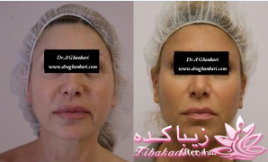 لیفت کردن بدون بیهوشی