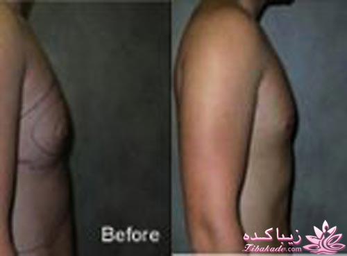 لیپولیز - لیپوماتیک - لیپوساکشن