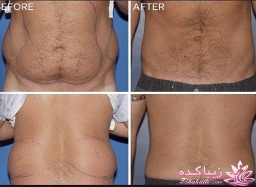 لیپولیز - لیپوماتیک - لیپوساکشن