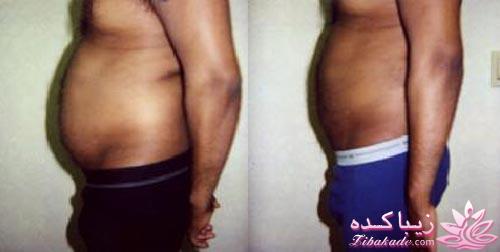 لیپولیز - لیپوماتیک - لیپوساکشن