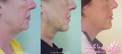 لیپولیز - لیپوماتیک - لیپوساکشن