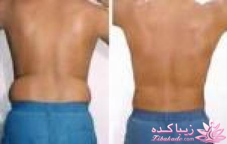 لیپولیز - لیپوماتیک - لیپوساکشن