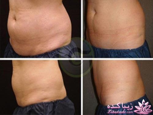 لیپولیز - لیپوماتیک - لیپوساکشن
