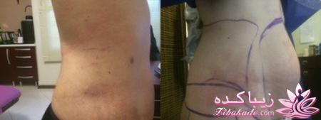 لیپولیز - لیپوماتیک - لیپوساکشن