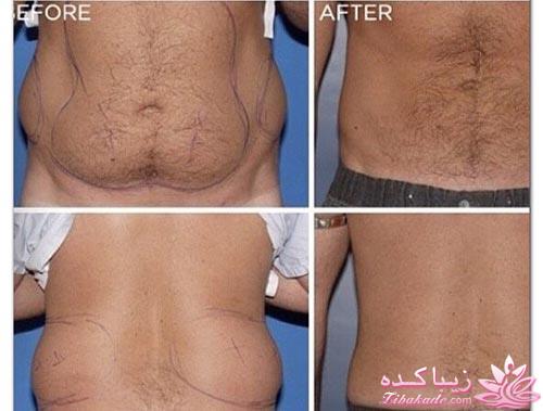 لیپوماتیک - لیپولیز - لیپوساکشن