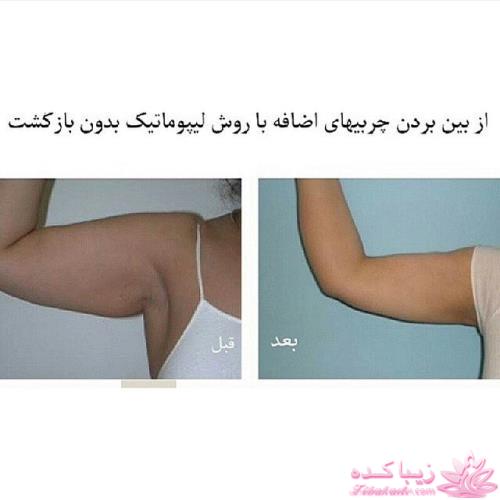 لیپوماتیک - لیپولیز - لیپوساکشن