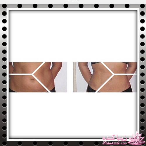 لیپوماتیک - لیپولیز - لیپوساکشن