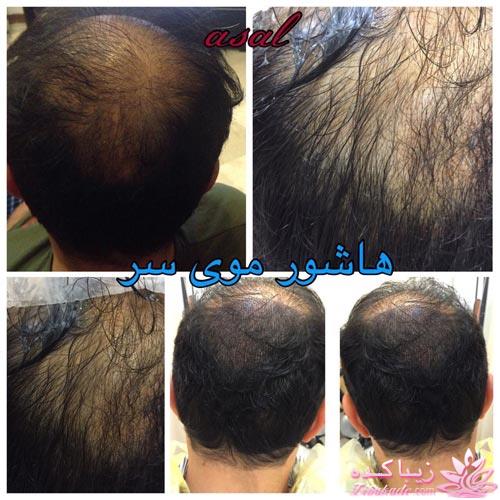 هاشور ابرو - میکروپیگمنتیشن - عسل