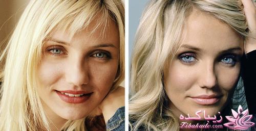 جراحی بینی - جراحی زیبایی