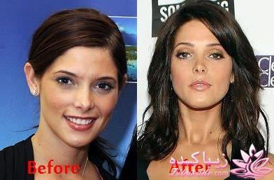 جراحی بینی - جراحی زیبایی