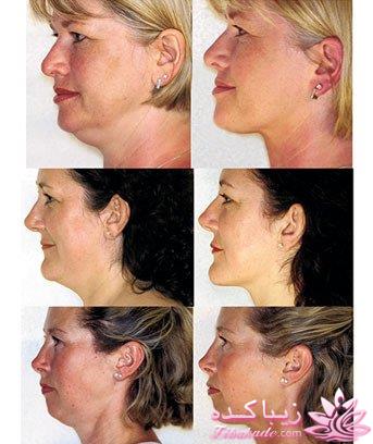 اگه غبغب دارین و مزاحم زیباییتون شده اینجا رو بخونید