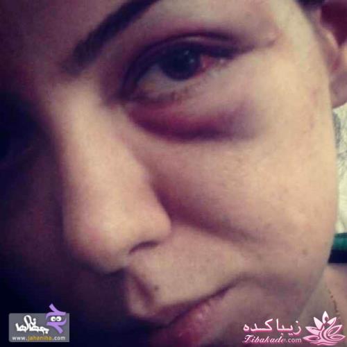 کتک خوردن ازاده نامداری ازهمسرسابقش فرزادحسنی