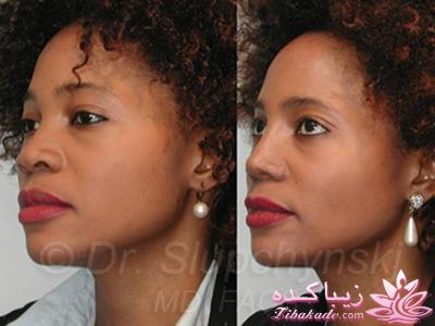 جراحی بینی - جراحی زیبایی