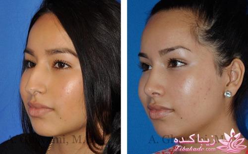 جراحی بینی - جراحی زیبایی